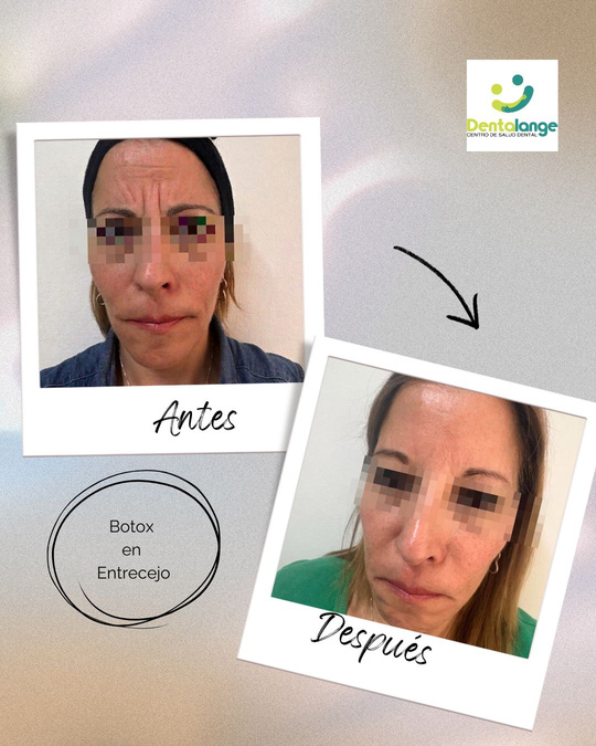 Botox Entrecejo - Caso 1
