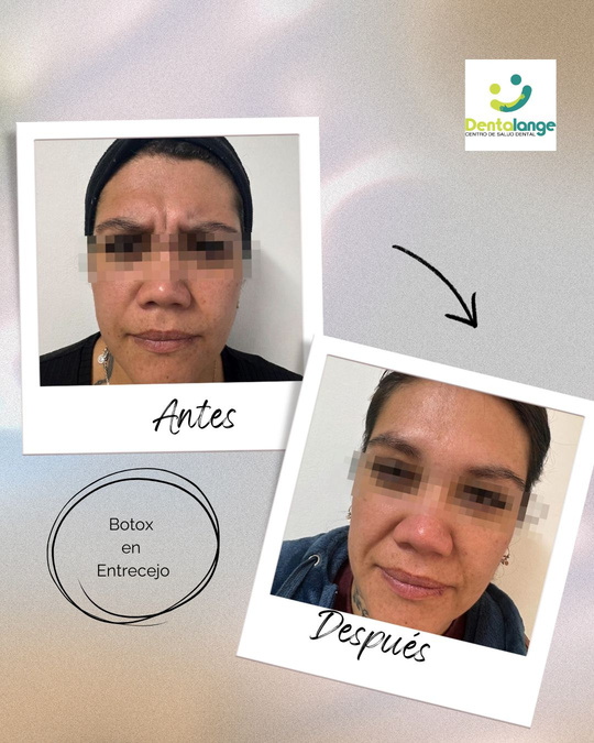 Botox Entrecejo - Caso 2