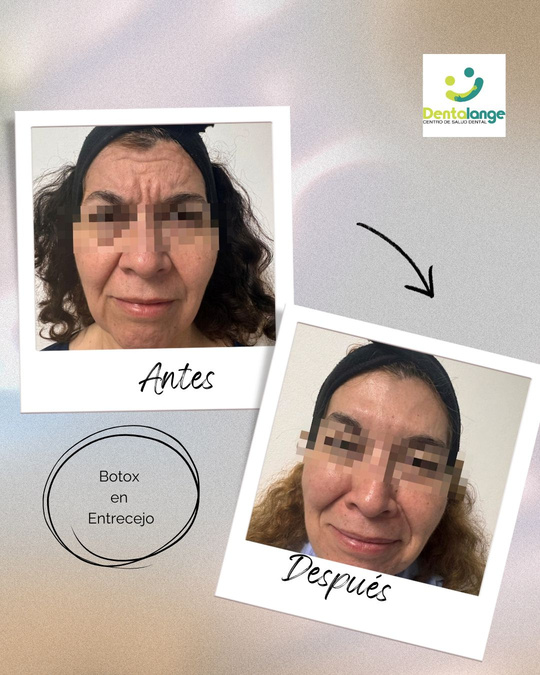 Botox Entrecejo - Caso 3