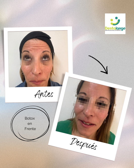 Botox Frente - Caso 1