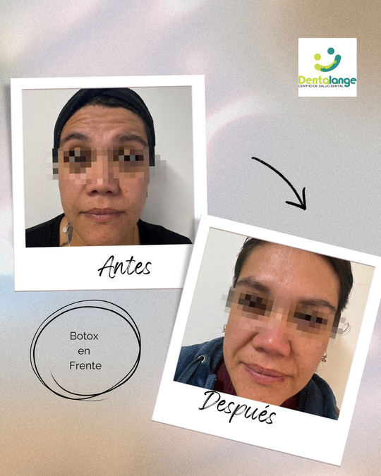 Botox Frente - Caso 2