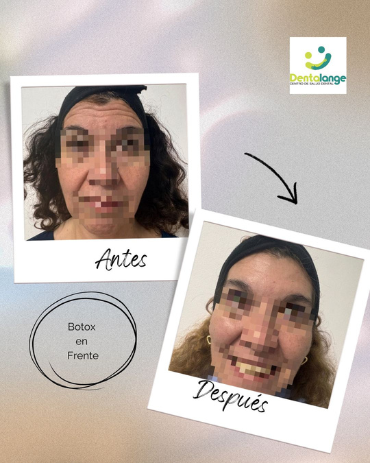 Botox Frente - Caso 3